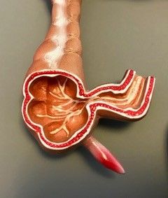 Schéma d'une appendicite Schéma d'une appendicite