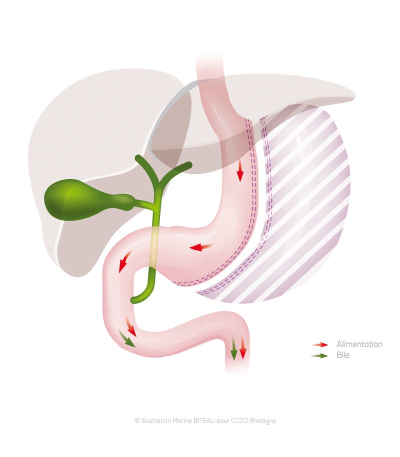Schéma d'une sleeve gastrectomie Schéma d'une sleeve gastrectomie