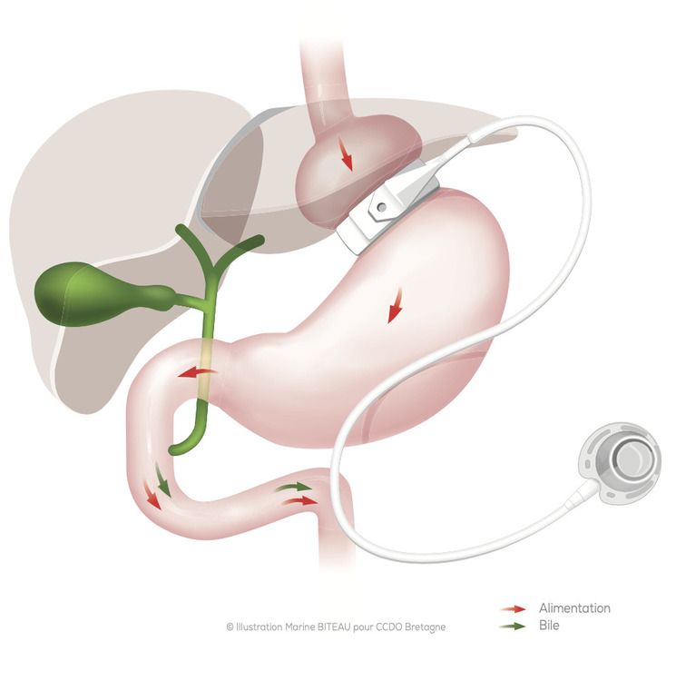 Illustration d'un anneau gastrique posé Illustration d'un anneau gastrique posé