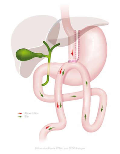 Schéma d'un Bypass gastrique avec anse en oméga - ccdo Bretagne Schéma d'un Bypass gastrique avec anse en oméga - ccdo Bretagne