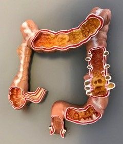 Schéma de Diverticules du colon