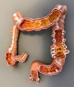 Schéma de Diverticules du colon Schéma de Diverticules du colon
