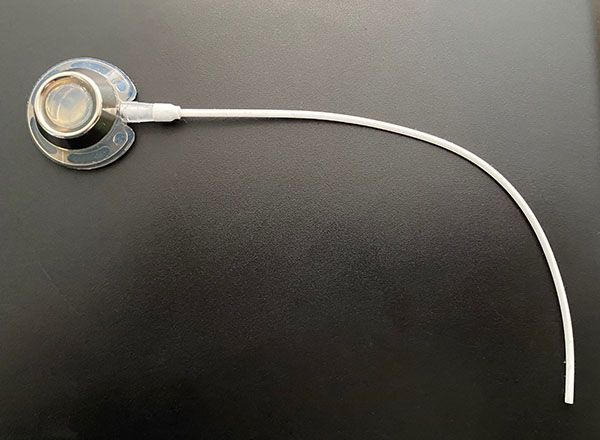 Pose d'une chambre implantable en image Pose d'une chambre implantable en image