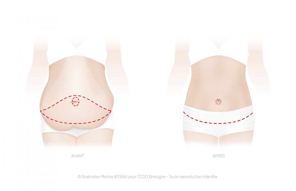 Tablier abdominal après chirurgie de l’obésité CCDO Bretagne