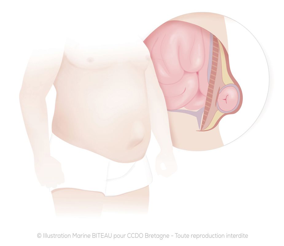 Hernie ombilicale - Paroi et tablier abdominal - CCDO Bretagne